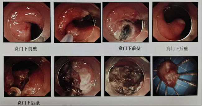 炎夏漸至，“胃腸”已碌 ——狹小的空間見證消化內(nèi)鏡微創(chuàng)手術(shù)的魅力(圖2)