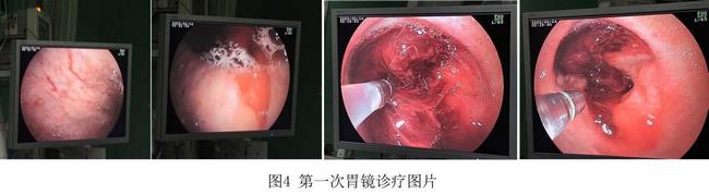 癡呆老人命懸一線，內(nèi)鏡止血彰顯奇功(圖2)