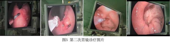 癡呆老人命懸一線，內(nèi)鏡止血彰顯奇功(圖3)