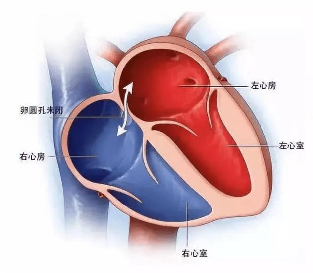 探尋不明原因卒中、偏頭痛根源的檢查技術—TCD發(fā)泡試驗(圖1)