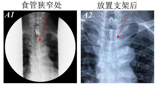 消化科運(yùn)用多學(xué)科會(huì)診（MDT）微創(chuàng)診治食管惡性腫瘤侵潤(rùn)所致食、氣道梗阻(圖4)