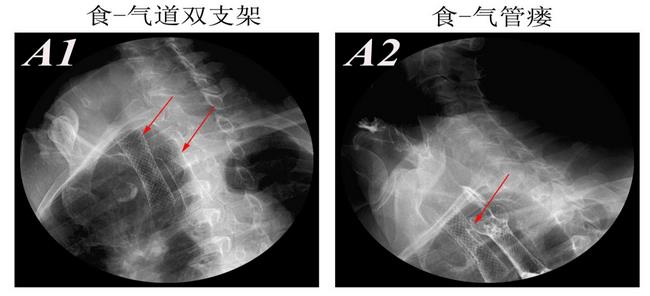 消化科運(yùn)用多學(xué)科會(huì)診（MDT）微創(chuàng)診治食管惡性腫瘤侵潤(rùn)所致食、氣道梗阻(圖8)
