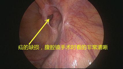 切口小，當(dāng)天即可生活自理——外三科開展腹腔鏡下疝氣手術(shù)(圖1)