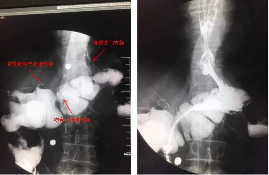 三個支架植入后——我院脾胃病1科成功為腫瘤患者施行內(nèi)鏡下高難度多支架植入術(shù)(圖6)